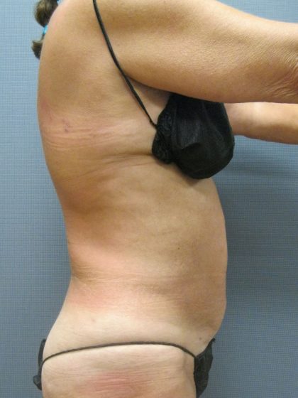 Liposuction Female Before & After Patient #1184