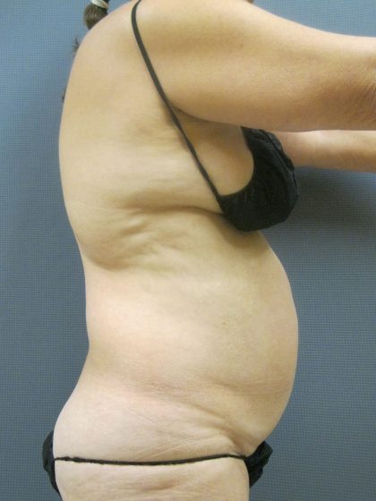 Liposuction Female Before & After Patient #1184