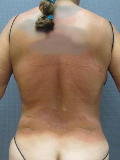 Liposuction Female Before & After Patient #1184
