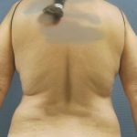 Liposuction Female Before & After Patient #1184