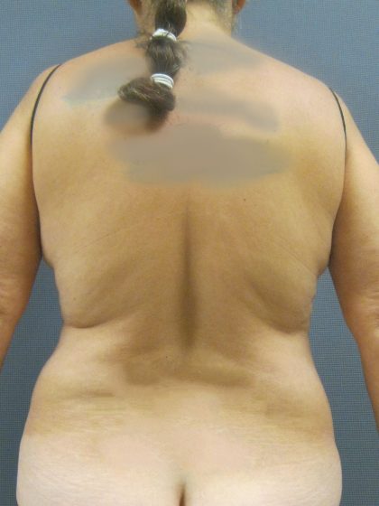 Liposuction Female Before & After Patient #1184