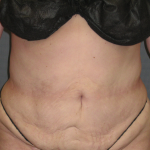 Liposuction Female Before & After Patient #1076