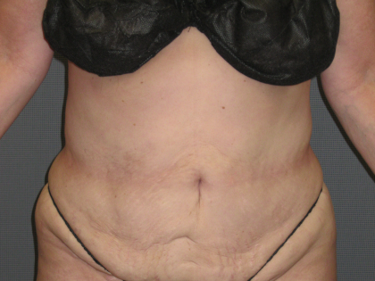 Liposuction Female Before & After Patient #1076