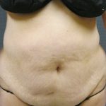 Liposuction Female Before & After Patient #1076