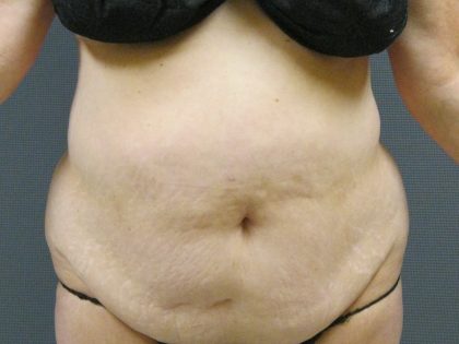 Liposuction Female Before & After Patient #1076