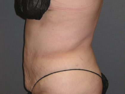 Liposuction Female Before & After Patient #1076