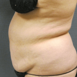 Liposuction Female Before & After Patient #1076