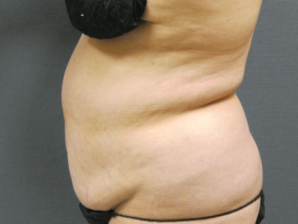 Liposuction Female Before & After Patient #1076