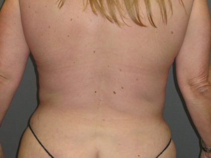 Liposuction Female Before & After Patient #1076