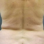 Liposuction Female Before & After Patient #1076