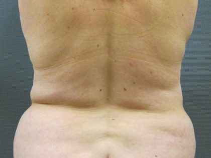 Liposuction Female Before & After Patient #1076