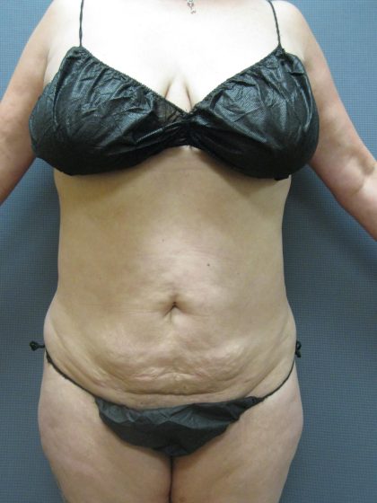Liposuction Female Before & After Patient #1062