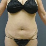 Liposuction Female Before & After Patient #1062