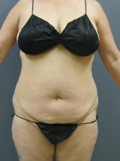 Liposuction Female Before & After Patient #1062