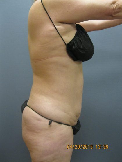 Liposuction Female Before & After Patient #1062