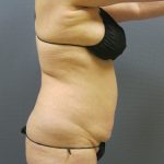 Liposuction Female Before & After Patient #1062