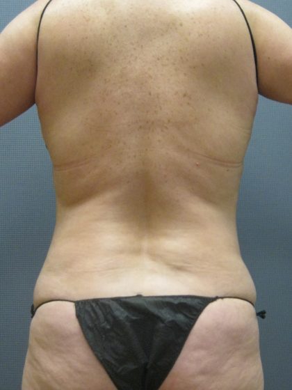 Liposuction Female Before & After Patient #1062