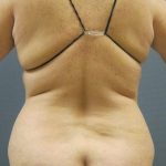Liposuction Female Before & After Patient #1062