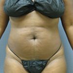 Liposuction Female Before & After Patient #1069