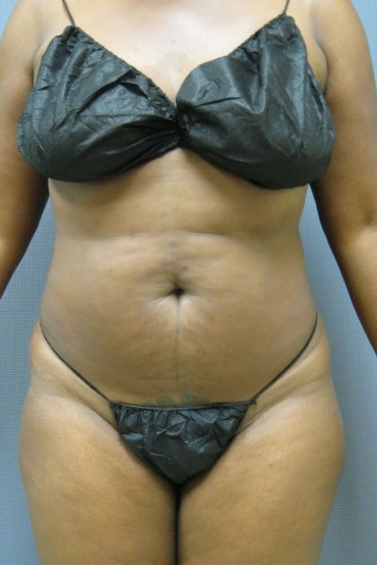 Liposuction Female Before & After Patient #1069