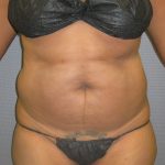 Liposuction Female Before & After Patient #1069