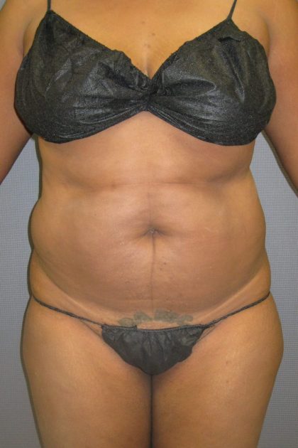 Liposuction Female Before & After Patient #1069