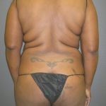 Liposuction Female Before & After Patient #1069