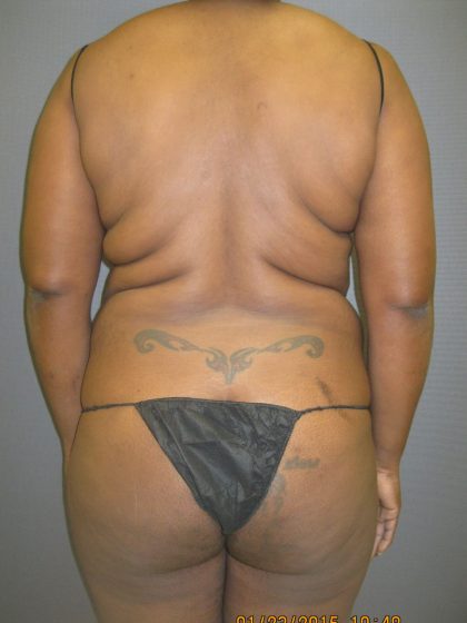 Liposuction Female Before & After Patient #1069