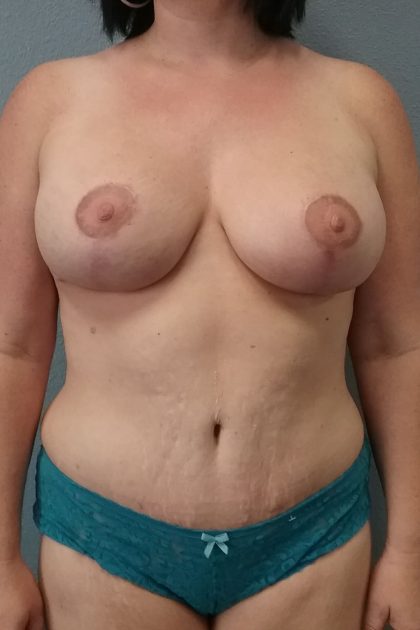 Mastopexy (Breast Lift) Before & After Patient #731