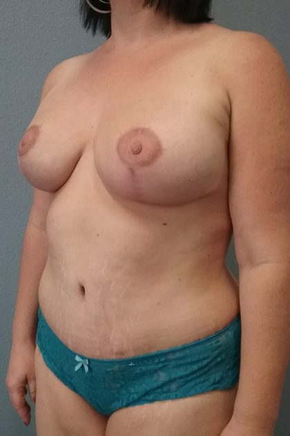 Mastopexy (Breast Lift) Before & After Patient #731