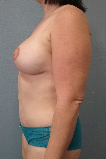 Mastopexy (Breast Lift) Before & After Patient #731