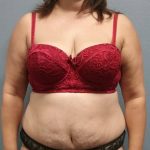 Abdominoplasty Before & After Patient #2215