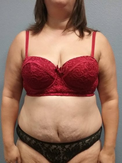 Abdominoplasty Before & After Patient #2215