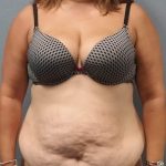 Abdominoplasty Before & After Patient #2215