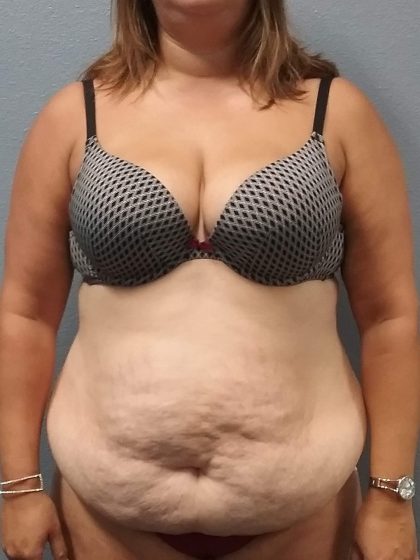 Abdominoplasty Before & After Patient #2215