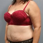 Abdominoplasty Before & After Patient #2215