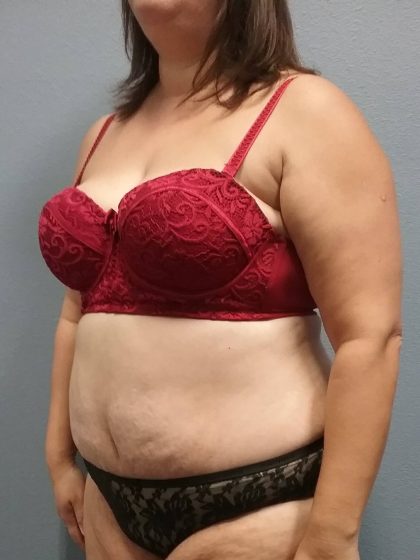Abdominoplasty Before & After Patient #2215