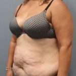 Abdominoplasty Before & After Patient #2215