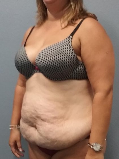 Abdominoplasty Before & After Patient #2215