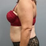 Abdominoplasty Before & After Patient #2215
