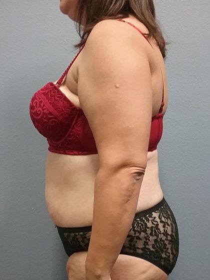 Abdominoplasty Before & After Patient #2215