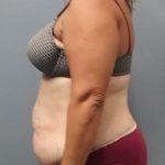 Abdominoplasty Before & After Patient #2215