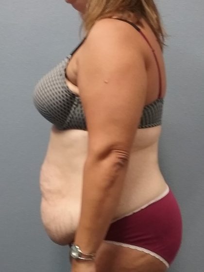 Abdominoplasty Before & After Patient #2215