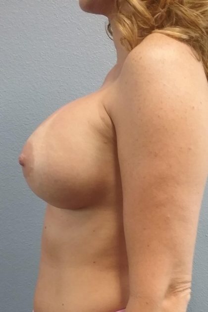 Breast Augmentation Before & After Patient #1593