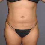 Liposuction Female Before & After Patient #1108