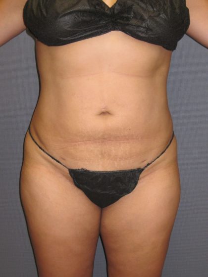 Liposuction Female Before & After Patient #1108