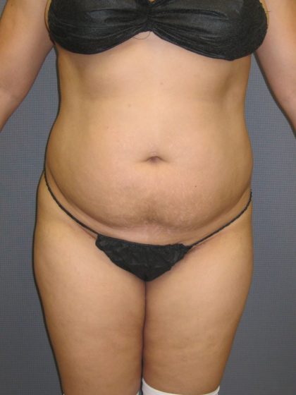 Liposuction Female Before & After Patient #1108