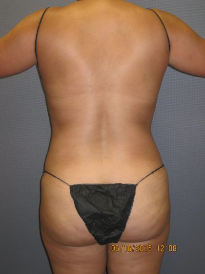 Liposuction Female Before & After Patient #1108