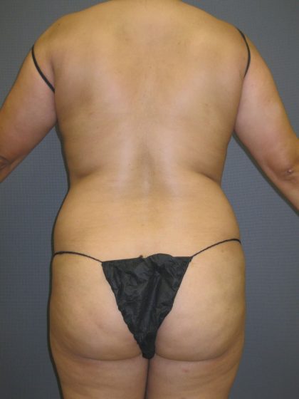 Liposuction Female Before & After Patient #1108