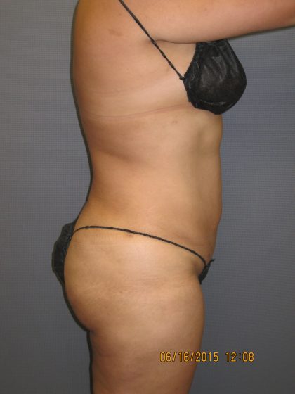 Liposuction Female Before & After Patient #1108